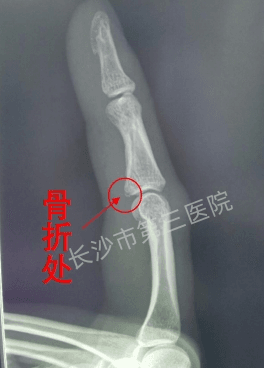 啪！女子一巴掌打蚊子「手指腫脹疼痛」　到醫院檢查竟「骨折了」