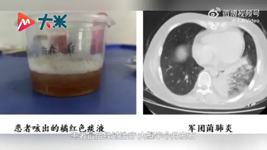 影/32歲OL發燒狂咳「橘紅色痰液」險喪命　染退伍軍人病只因「冷氣沒洗」
