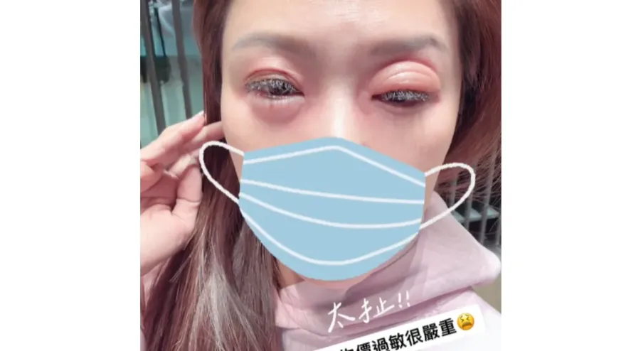 不只名牌包被偷！佩甄旅遊大過敏　眼皮突「腫到變形」慘況曝光