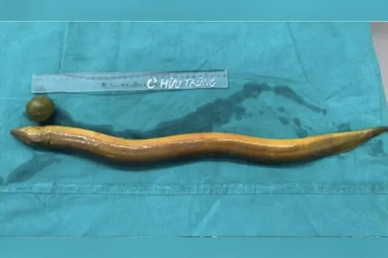 沒事幹！他將「65cm活鰻硬塞肛門」嚴重腹痛　開刀驚見「腸被咬破」還挖出檸檬