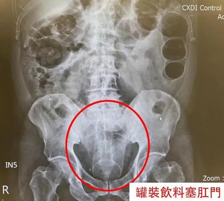 影/苗栗50歲男肛門塞「13公分柱狀物」醫取出蘆筍汁罐沾血變形