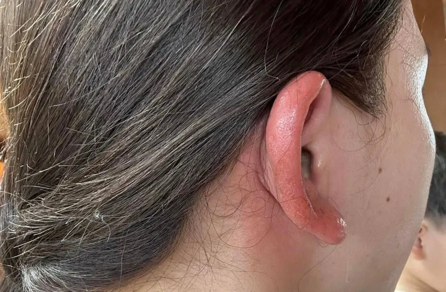 真是鐵齒！妹子貪美「便宜耳環強插耳洞」　醫驚呆：最嚴重要切掉治療