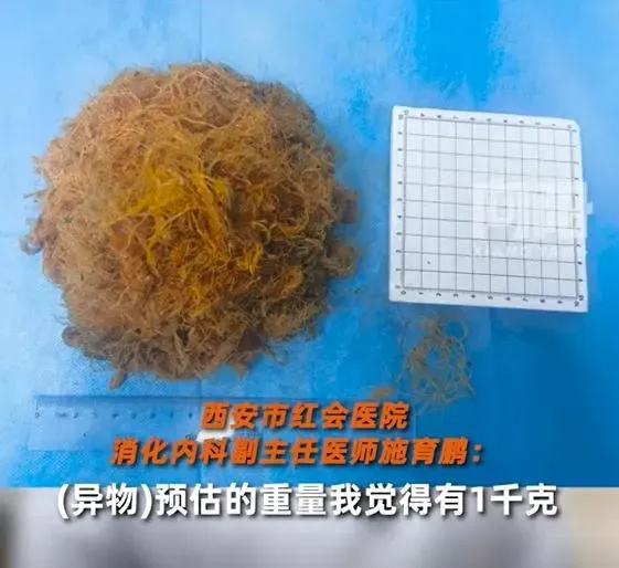 影/這肉鬆？陸女「異食癖」狂吞塑膠袋腹痛　醫驚呆取出