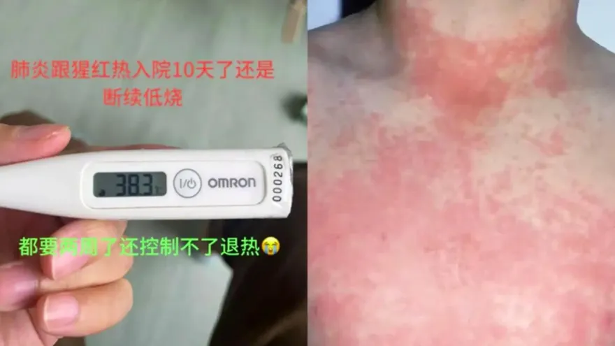 無疫苗！廣東爆「猩紅熱」1月確診2328例　醫：兒童易染