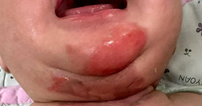 家長嘗試「蒸氣緩解鼻塞」害嬰燙傷！醫示警：刺激鼻黏膜