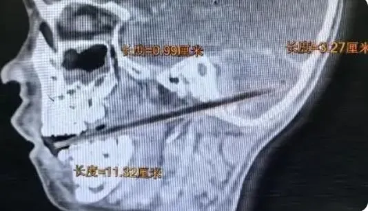爸媽崩潰！吃麥芽糖不慎摔倒…陸童「竹籤從口插進小腦」