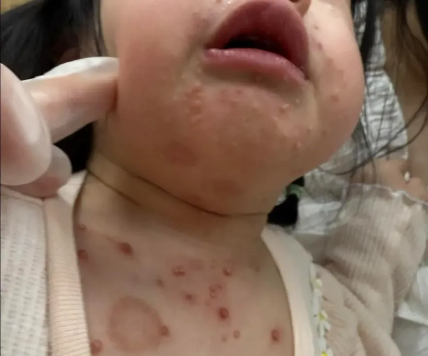 染「傳染性軟疣」小朋友變多了！醫搖頭：一發不可收拾