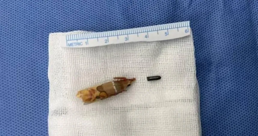 8歲妹被鉛筆刺傷竟慢性骨髓炎　醫開刀驚：筆芯還嵌在腳裡