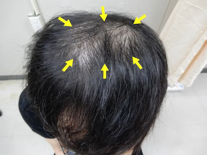 3旬男「頭髮越來越少」以為雄性禿　一驗竟是梅毒二期