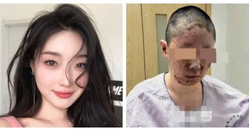 父親一根菸引爆炸！女網紅家毀人傷　「臉被燒爛」拍片自救籌200萬
