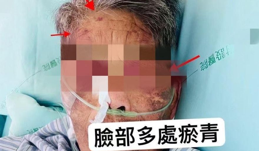 影/台中嬤莫名「瘀青」滿身傷　家屬驚見看護揮打氣炸