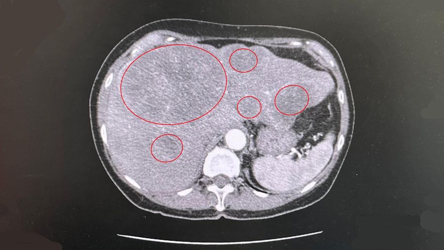 肛門出血當痔瘡！台中婦肝臟一照「一堆腫瘤」　直腸癌轉移
