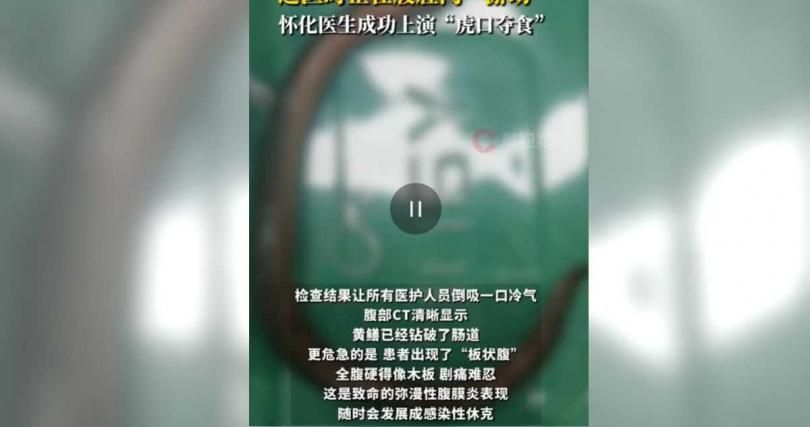 玩好大？　陸30歲男腸內驚見30公分黃鱔