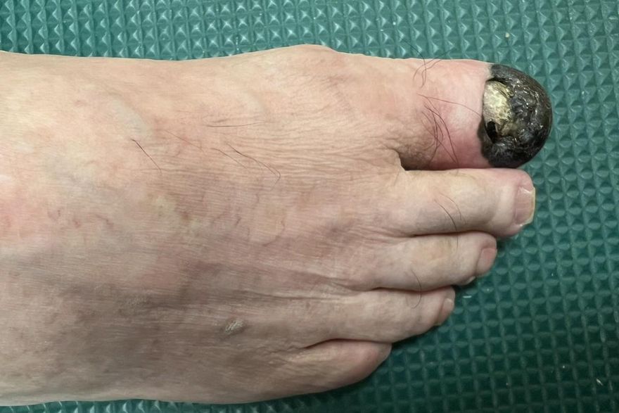 誤以為是瘀青！76歲翁腳趾黑斑…竟是肢端黑色素瘤