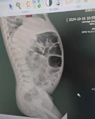 罕見！陸5歲童天生「沒有肛門」　靠「尿道排便」嚇傻醫