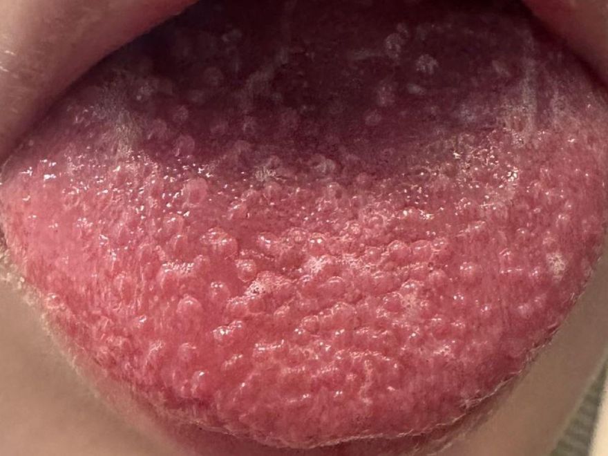 9歲童高燒不退還出現「草莓舌」！就醫確診猩紅熱