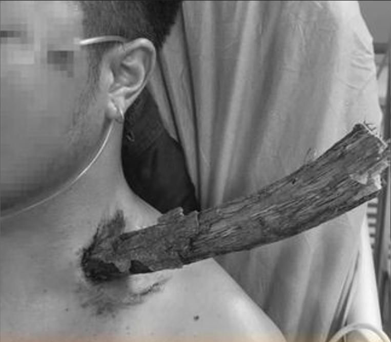樹下路過「3cm粗」枯枝突插頸穿胸 　陸男因「1事」逃死