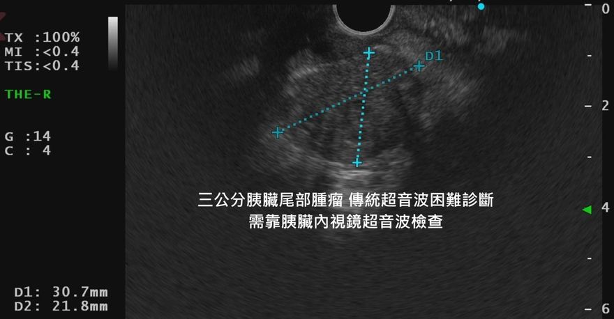 「胰臟癌」潛伏太兇！　醫示警：3種症狀別輕忽