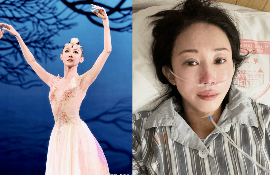 陸知名舞蹈家自曝罹癌！接受25次放化療　帶傷口赴春晚彩排