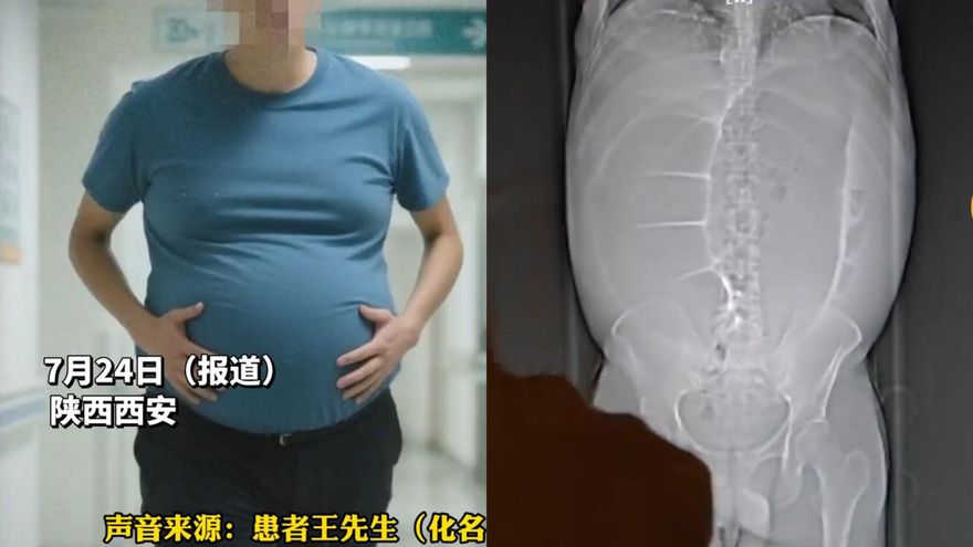 影/滿肚子大便！陸大叔動手術卸載「10分鐘狂排20公斤」