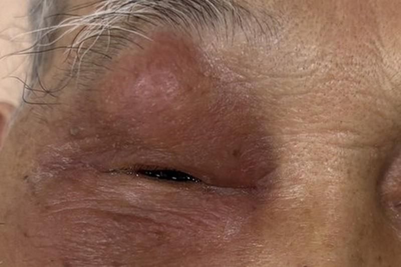 84歲翁「急性鼻竇炎」害眼睛腫脹！醫：嚴重恐致腦膜炎