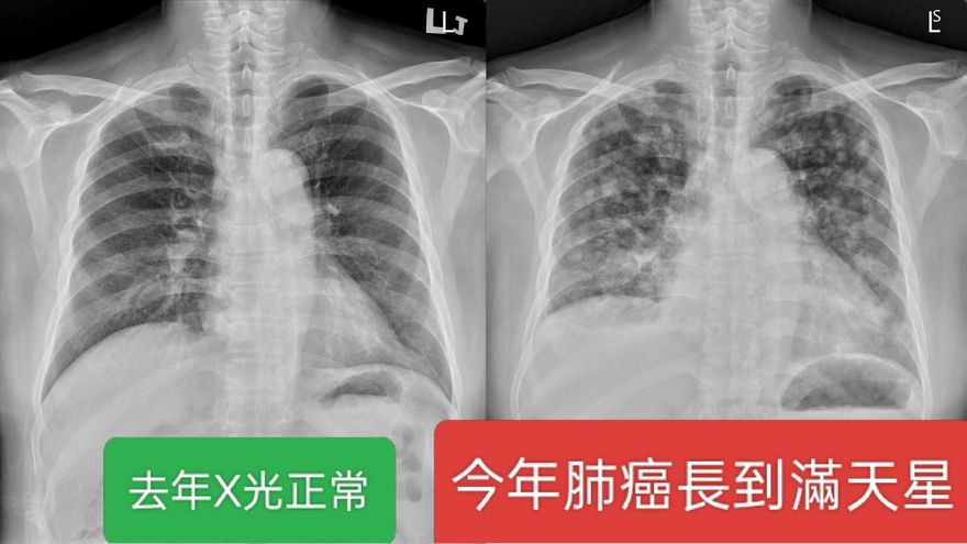 每年照X光都正常　男子竟驗出滿天星肺癌末期