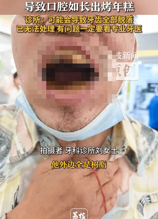 天津男網購樹脂「補牙DIY」　醫搖頭：口腔糊成「烤年糕」