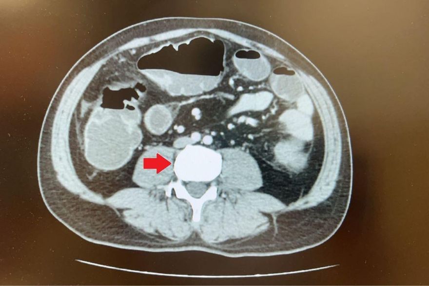 45歲男腹脹3天未排便　就醫見5公分大腫瘤慘罹大腸癌