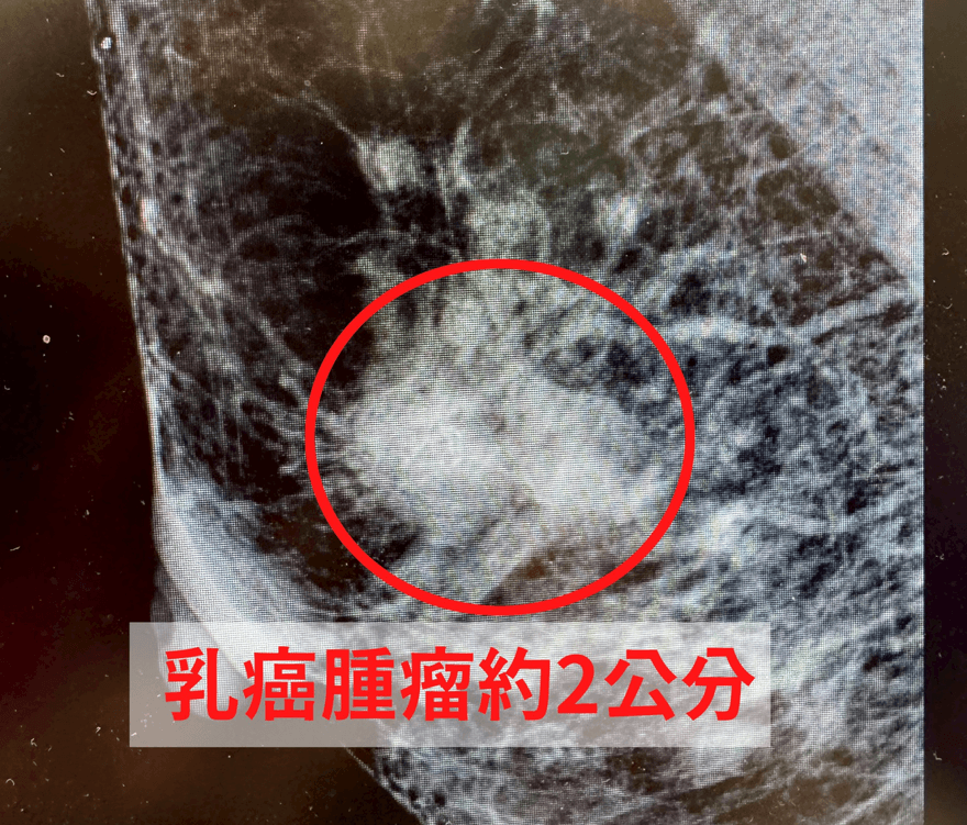 6旬婦「乳頭濕疹」3個月未癒…竟確診罕見乳癌第二期