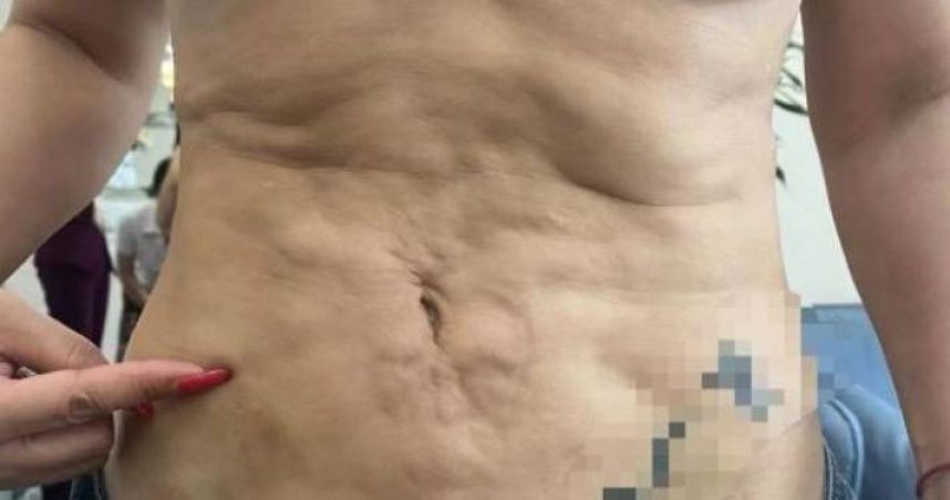 抽脂失敗腹部變「月球坑」遭老公嫌棄提離婚　人妻怒討說法…院方回應了
