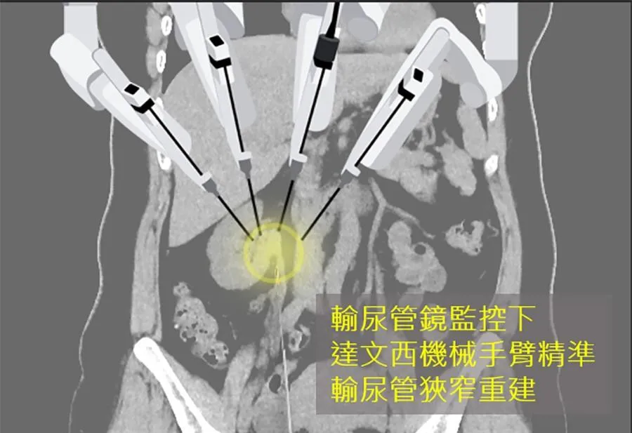 一名46歲國中女教師因右側輸尿管反覆結石，導致輸尿管結疤狹窄，不僅經常腰痛、夜間痛醒，更出現腎臟水腫症狀。（圖／澄清醫院）