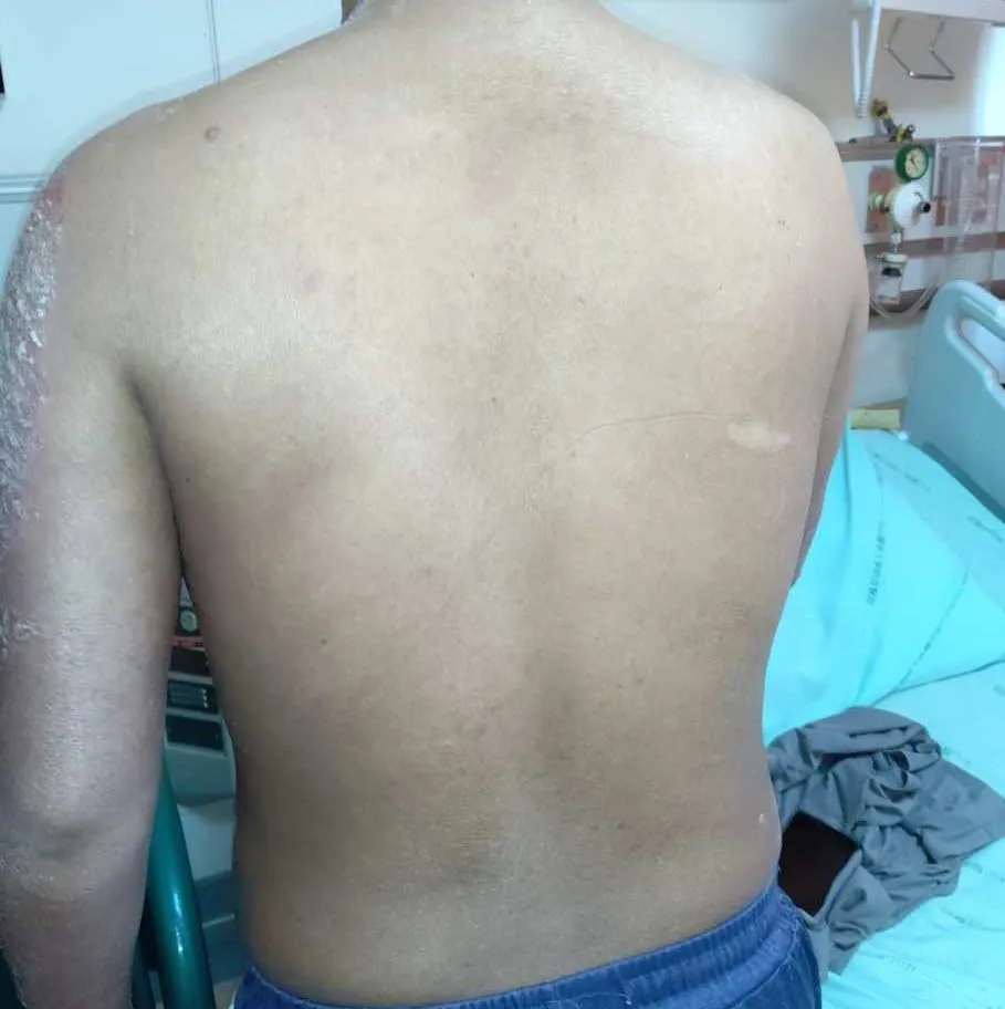 檢查後發現男子帶有全球罕見的IL36RN基因純合子突變，經健保給付急性生物製劑治療後順利康復出院。&nbsp;(圖/中山附醫提供)
