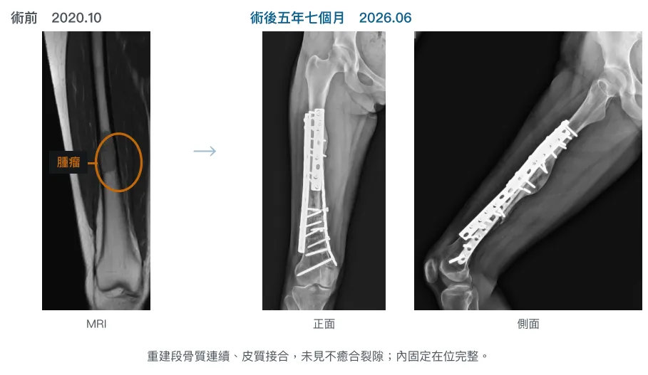 病友接受「免截骨／少截骨」冷凍治療的手術前後 X 光照片對比，可見術後 5 年骨頭生長良好且結構更為強壯。（圖／台北榮總）