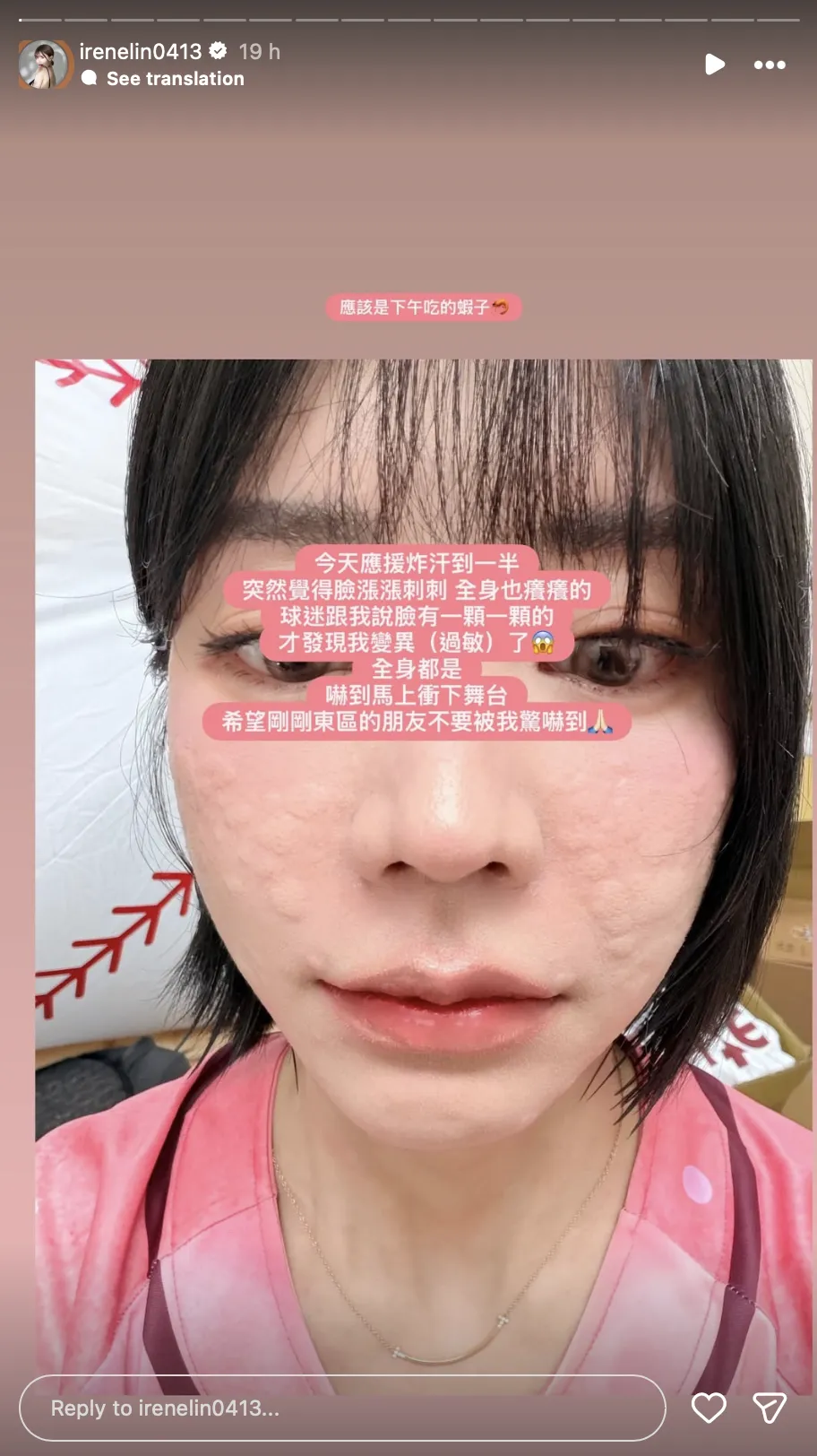 林艾融發過敏自拍，臉蛋布滿紅腫疹子，直言是吃蝦惹禍，球迷看了直呼心疼。（圖／翻攝自林艾融IG）
