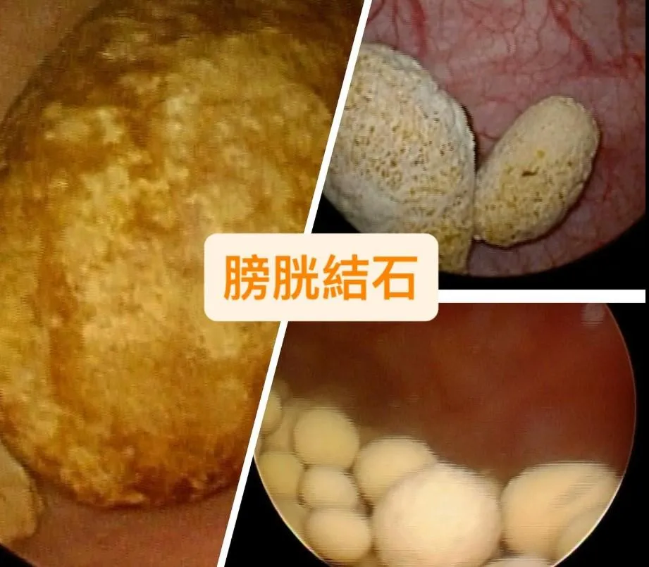 如果結石是「阻塞」造成的結果，只把石頭處理掉，尿速通常不會加快，解尿的問題仍然存在。（圖／翻攝自曾浩翔醫師臉書）