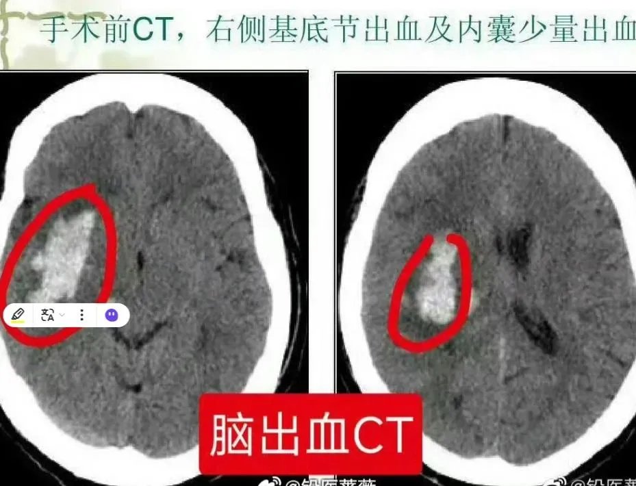 醫師曝光男子腦出血情形。(圖/翻攝新浪微博)