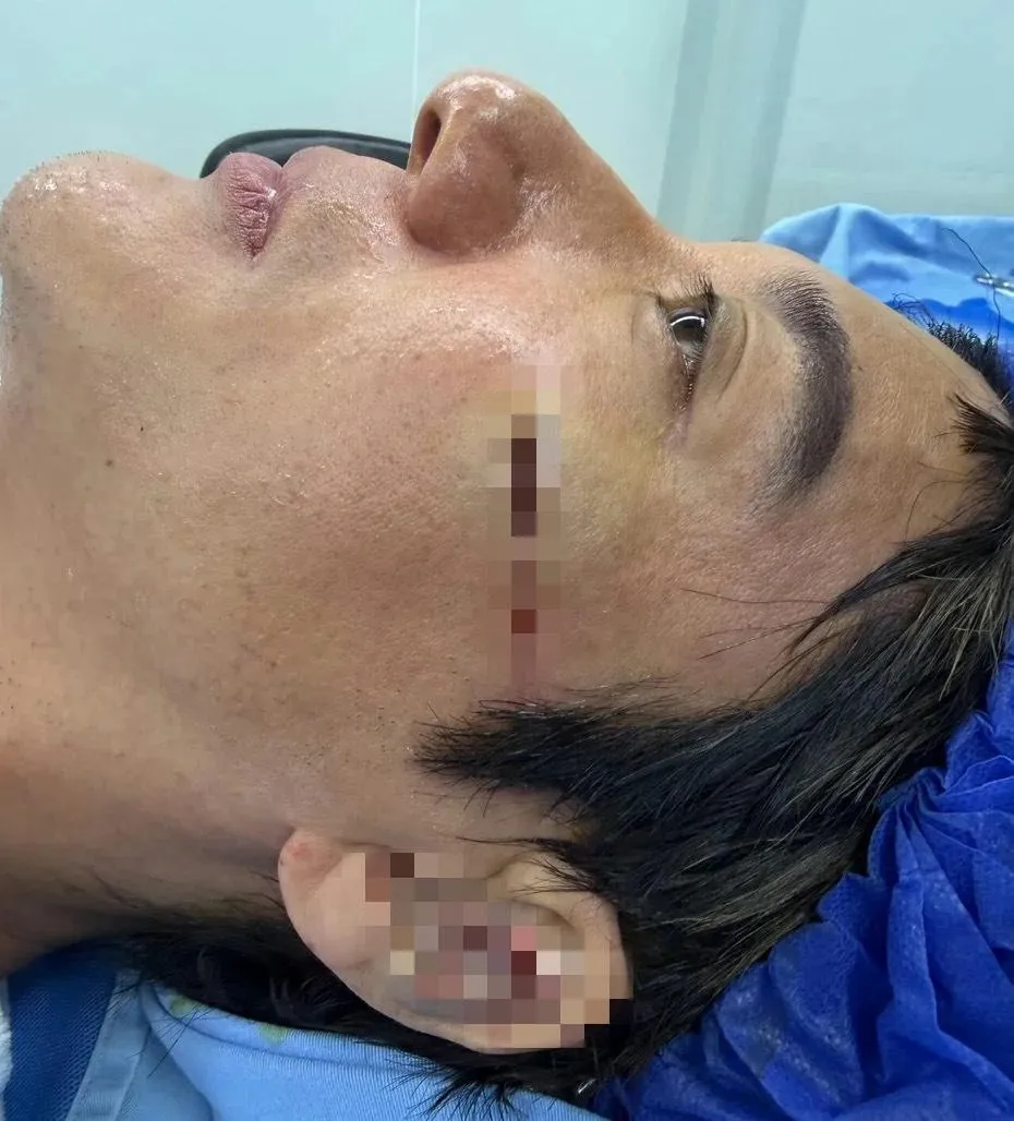 王力宏近期在成都進行巡演時發生重摔意外，導致左耳外耳軟骨碎裂、臉部撕裂傷。（圖／翻攝微博）