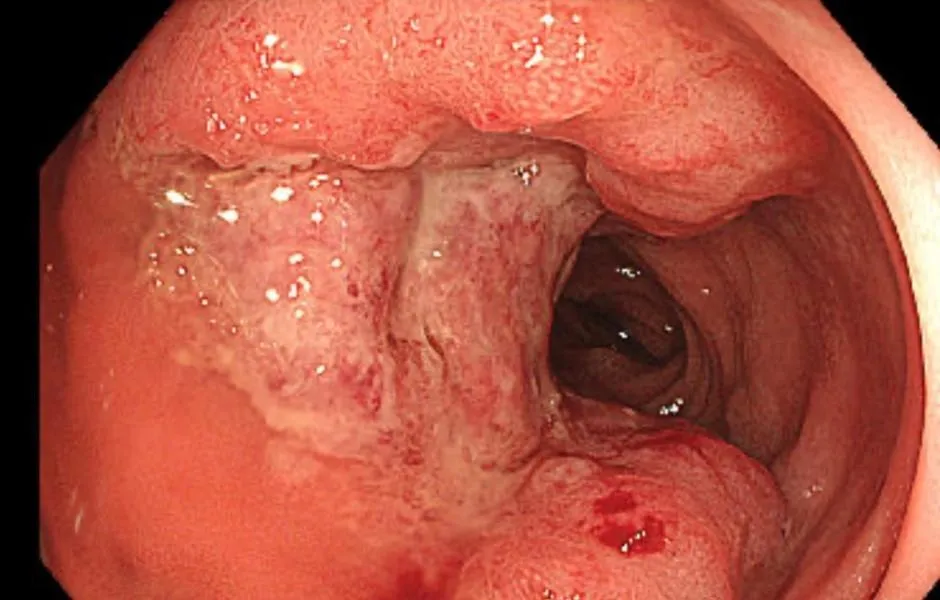 林男接受無痛腸胃內視鏡檢查發現他的大腸內有一顆大型腫瘤，已經佔據腸道約三分之二，確診為大腸癌。（圖／行健大直健康管理診所提供）