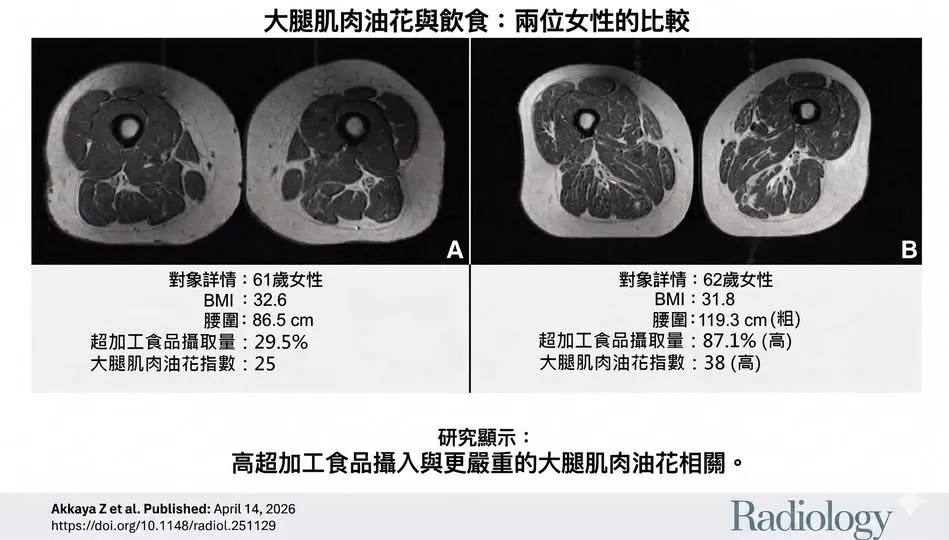 左側女性每日超加工食品攝取佔總熱量的29.5%，右側女性達87.1%。兩人腰圍及大腿肌肉的脂肪浸潤程度卻有天壤之別。（圖／翻攝自蔡明劼醫師 健康。瘦身臉書）
