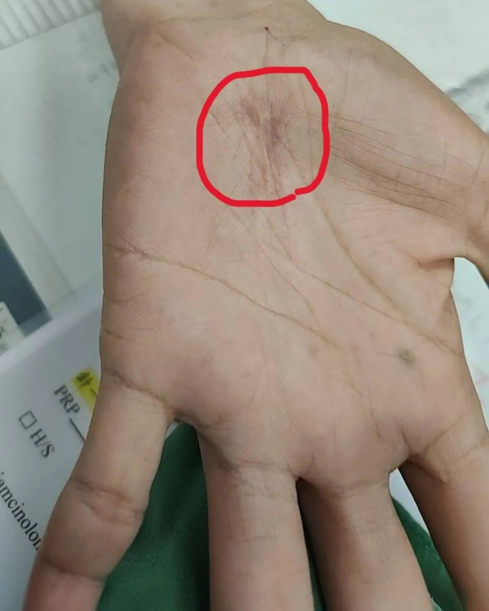 圖中紅圈為傳統開放式腕隧道減壓手術的典型切口位置,為切開壓迫正中神經的橫腕韌帶。(圖/員榮醫院)