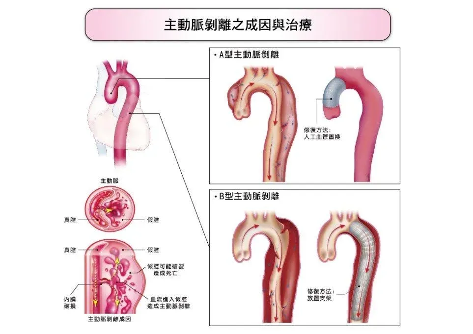 主動脈剝離之成因與治療(圖/長庚醫院提供)