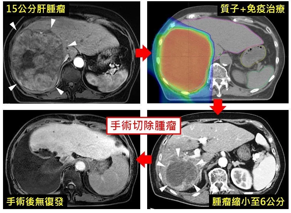 肝腫瘤15公分且侵犯血管，質子合併免疫治療縮至6公分，手術切除後，追蹤兩年未復發。（圖／長庚醫院提供）