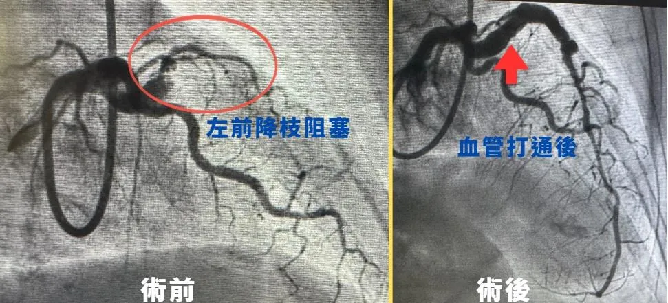 一名80歲三高男性因胸悶不適忍耐長達一週，送急診後確診急性心肌梗塞。（圖／中國醫藥大學新竹附設醫院）