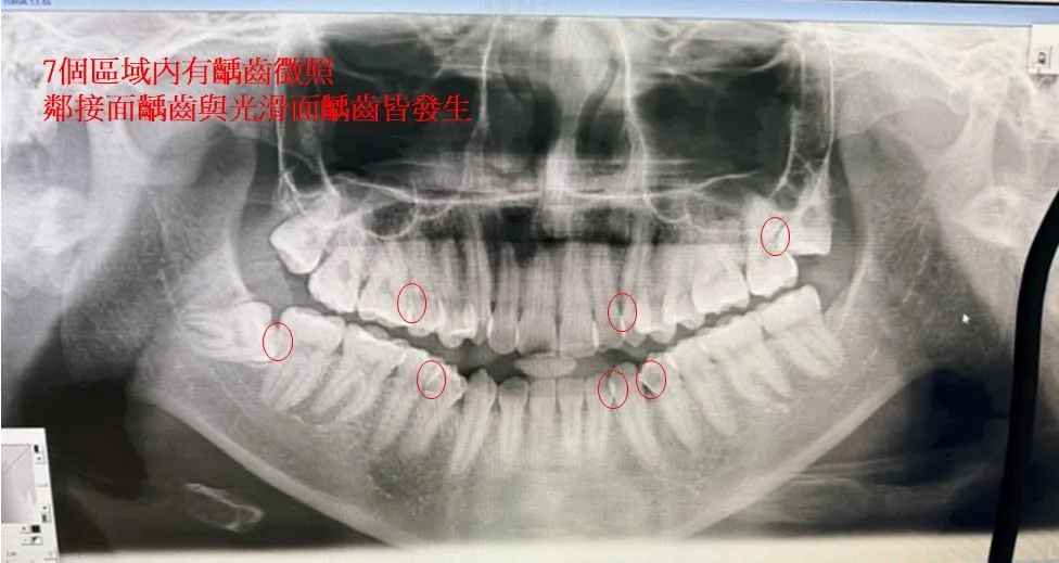 林佳詠主任說明30歲上班族,因為工作壓力大睡不好,經常半夜起來喝牛奶後未漱口就回床上睡,三個月竟出現七顆蛀牙,確診是「猛爆性齲齒」。(圖/臺中醫院)