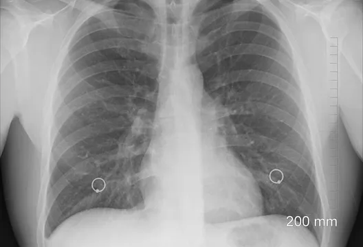 不吸菸也會罹肺癌 台大名醫揭3大隱形風險
