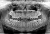 30歲女蛀牙「牙根變黑」不痛不理會　臉腫一查竟變「蜂窩性組織炎」
