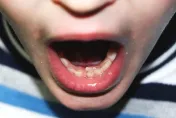 小朋友雙排牙要拔嗎？醫揭：乳齒會自然脫落、8歲是關鍵