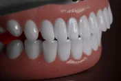 植牙能用多久？牙醫揭真相　口腔環境沒顧好恐白花錢