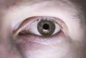 眼睛也會中風！57歲婦起床右眼模糊看不清　就醫發現竟「塞住了！」