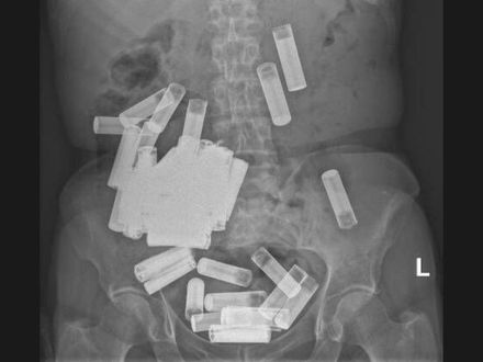 6旬婦肚子詭異脹痛！醫驚見「55顆電池」撐爆腸胃　驚悚X光照曝光